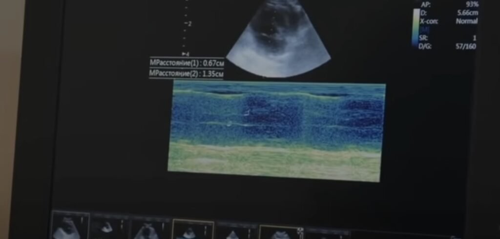 Ultraschallbild auf Monitor mit Messungen.